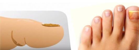 Champignon sur les ongles