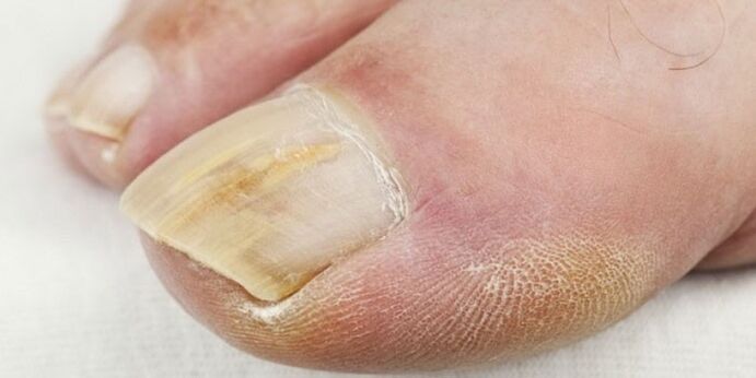 Symptômes de la mycose des ongles des pieds