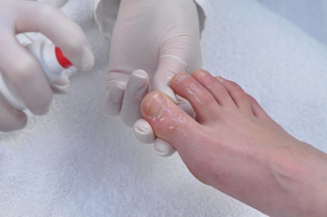 Spray pour traiter la mycose des ongles