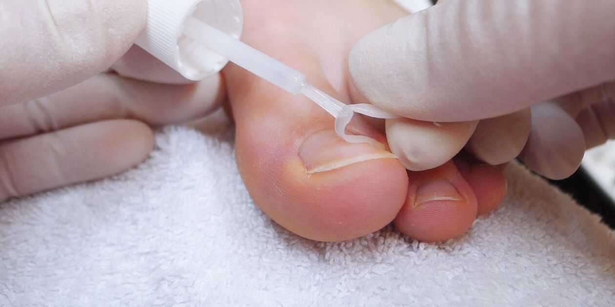 vernis médical contre la mycose des ongles