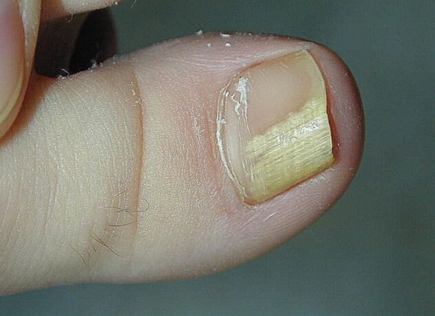 symptômes mycose des ongles