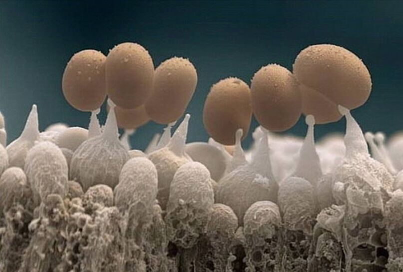 Mycose des ongles sous le microscope