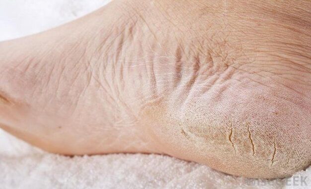 Les pieds secs sont un signe d'infection fongique