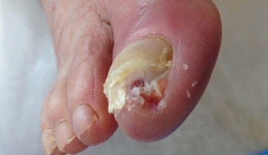Un ongle malade