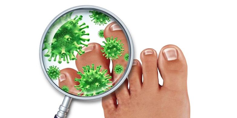 Nails infectés par un champignon