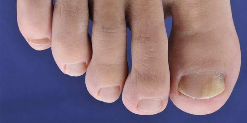Symptômes de la mycose cutanée et des plaques de ongles
