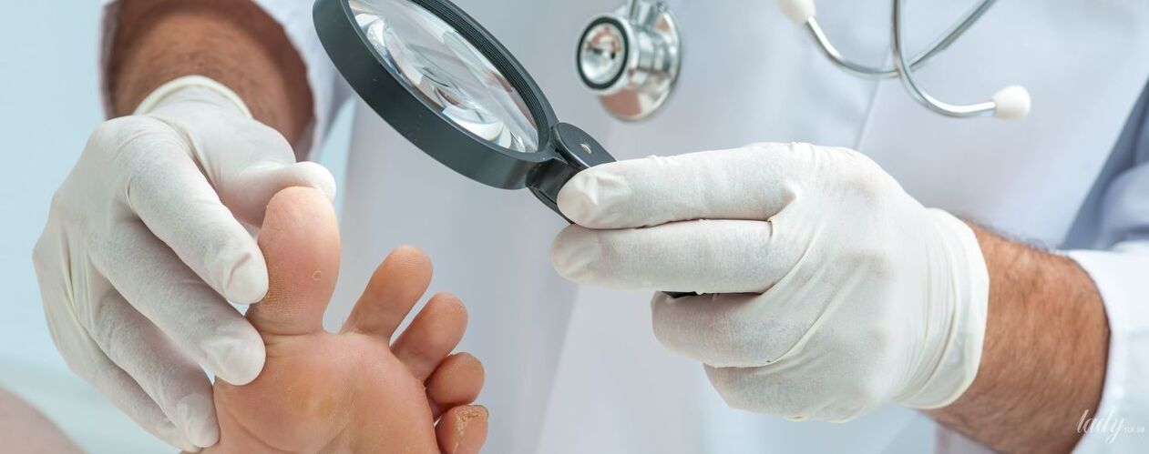 Le médecin examine le champignon sur l'orteil