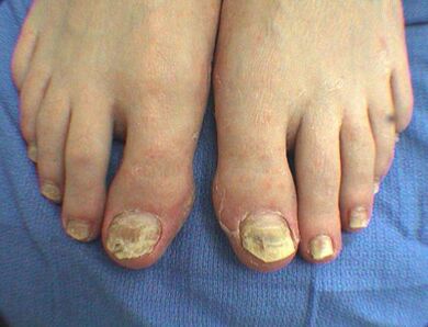 Symptômes des champignons de l'ongle