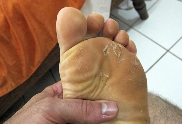 Champignon sur la peau des jambes