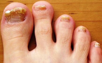 Ongles touchés par des champignons