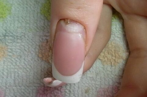 Symptômes de la mycose des ongles