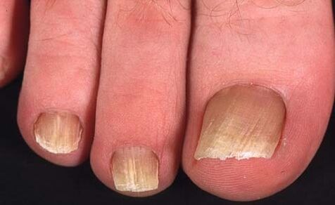 Type de champignon des ongles
