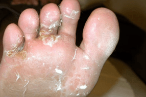 Champignon sur les doigts et les pieds