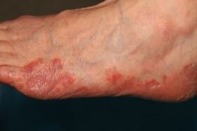 Manifestations de champignons sur les pieds