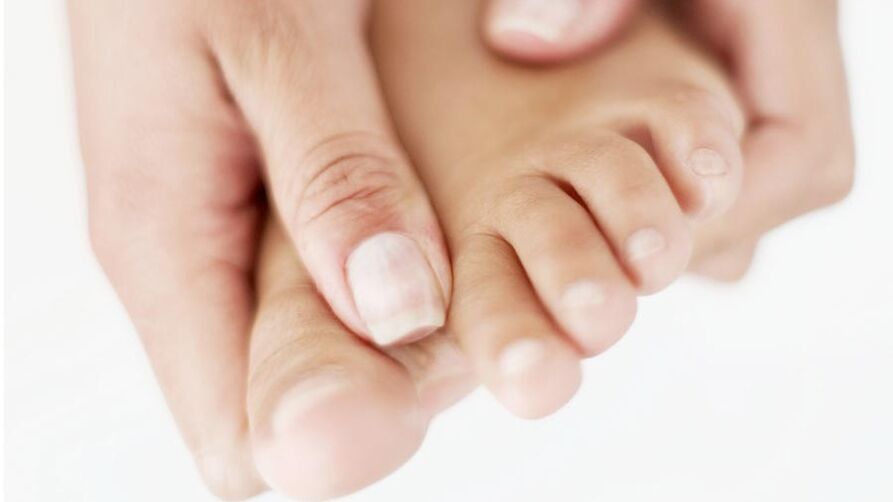 Démangeaisons causées par une mycose des ongles sur le gros orteil