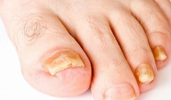 Photo des symptômes du champignon des ongles des pieds